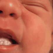How to Identify and Treat Oral Thrush While Breastfeeding How to Identify and Treat Oral Thrush While Breastfeeding